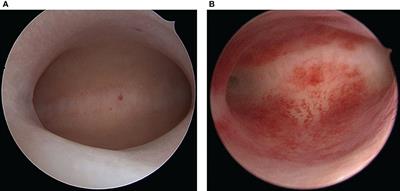Overexpression of hypoxia-inducible factor 1α and excessive vascularization in the peri-implantation endometrium of infertile women with chronic endometritis